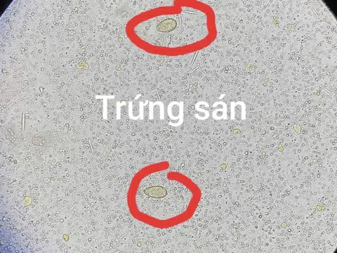 Thói quen xấu khó bỏ khiến người đàn ông hư gan, sán chi chít