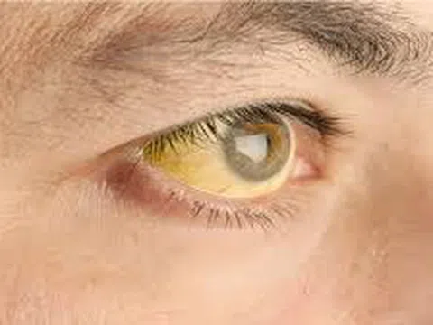 Bỗng vàng da, vàng mắt: Có thể là dấu hiệu cảnh báo gan mật đang gặp vấn đề