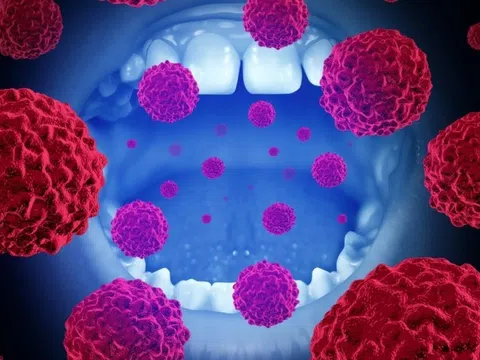 Thói quen âm thầm 'nuôi dưỡng' ung thư miệng