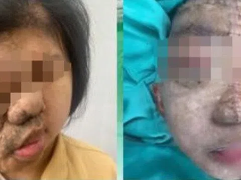 Cô gái 19 tuổi mang khối u khắp đầu mặt cổ được phẫu thuật
