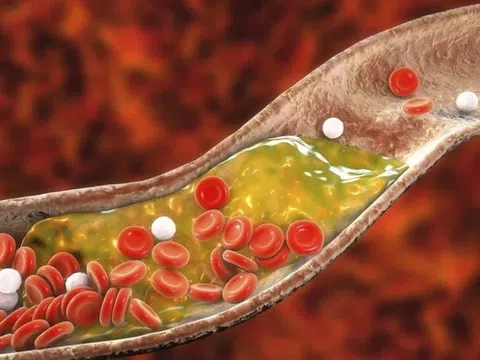 Kiểu ăn uống khiến mỡ máu tăng nhanh