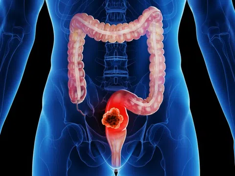 Một loại ung thư đang tăng nhanh báo động ở người trẻ