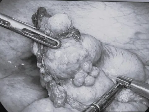 Đi khám vì một triệu chứng, đau xót phát hiện ung thư ruột thừa