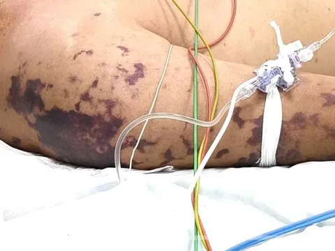 Thâm tím khắp người sau bữa tiệc vì nhiễm khuẩn não mô cầu