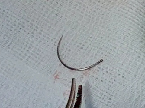 Lấy dị vật kim khâu nằm trong tầng sinh môn nữ bệnh nhân sau 11 năm