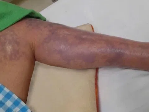 Tai nạn vô tình lúc chạm vào cá, người đàn ông lâm bạo bệnh