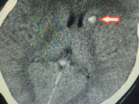 Mông, đùi chảy mủ sau khi tiêm chất làm đầy
