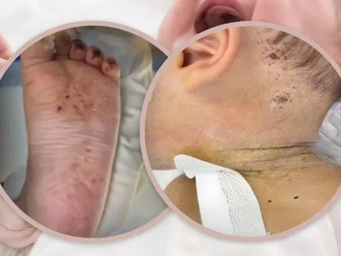 Bé 10 tháng tuổi suýt mất mạng vì bị mẹ châm kim hàng trăm lần để 'chữa bệnh'