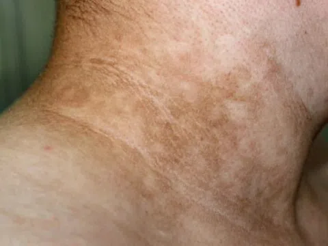 Dấu hiệu trên da chứng tỏ cơ thể bạn đang kháng insulin