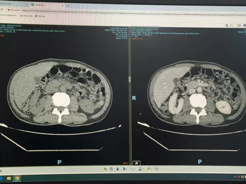 Thói quen sau bữa ăn khiến người đàn ông có cả ổ mủ trong gan