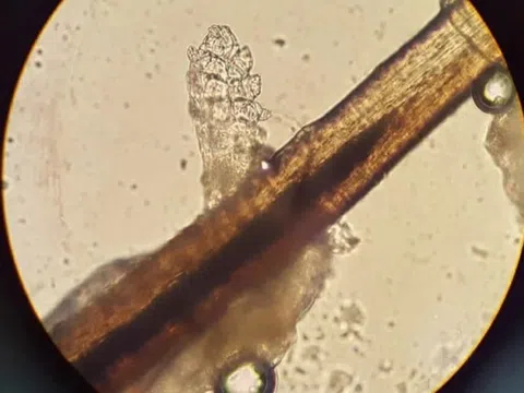 Hơn 60 con rận làm tổ trong mí mắt cô gái trẻ sau nối mi