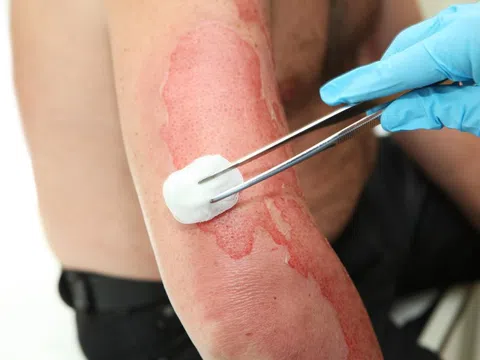 Bác sĩ TP.HCM cứu bé gái bị bỏng thương tâm 70% cơ thể