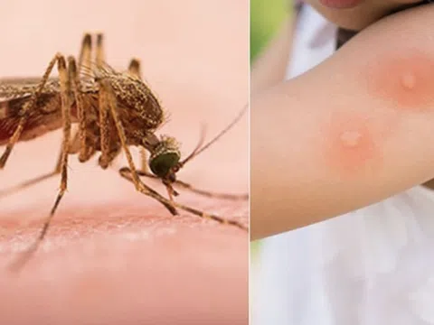 Du xuân an toàn: Cẩn thận côn trùng đốt, túi y tế mang theo cần gì?