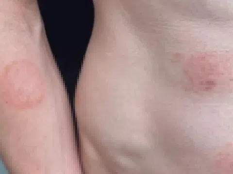 Một bệnh lây truyền qua đường tình dục đang lan rộng ở Mỹ