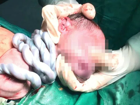 Thai nhi bị dây rốn quấn cổ 5 vòng