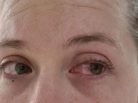 Bác sĩ cảnh báo tác dụng phụ đáng sợ, ít người biết đến của xăm hình