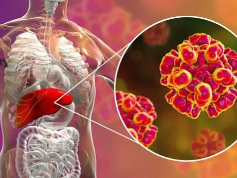 Đường lây và cách điều trị viêm gan E