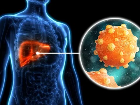 Dấu hiệu phổ biến nhất của viêm gan