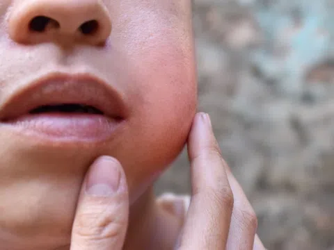 Bệnh quai bị bao lâu thì khỏi?