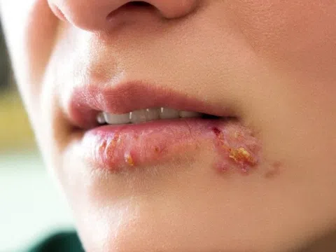 Chịu hậu quả vĩnh viễn vì chủ quan với nốt mụn rộp do Herpes