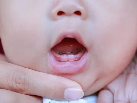 Dấu hiệu trẻ bắt đầu mọc răng đầu tiên
