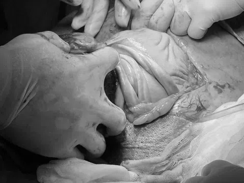 Em bé chào đời với dây rốn quấn cổ 4 vòng