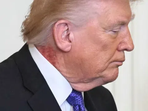 Bác sĩ Nhà Trắng lên tiếng về vết đỏ lạ trên cổ Tổng thống Trump