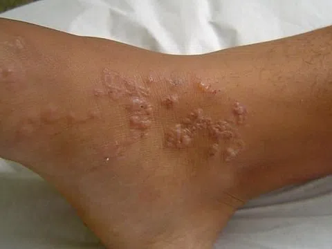 Thói quen xấu khiến thanh niên nhiễm cùng lúc 3 loại ký sinh trùng