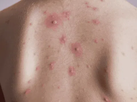 Xuất hiện ổ dịch, trường đại học Thái Lan chuyển sang học online