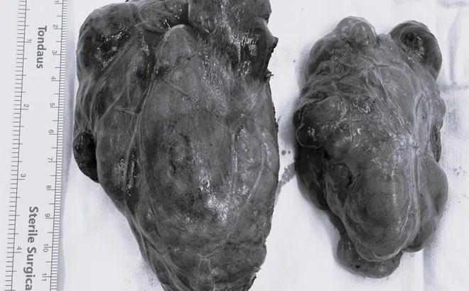 Người phụ nữ sống với khối bướu cổ suốt 40 năm