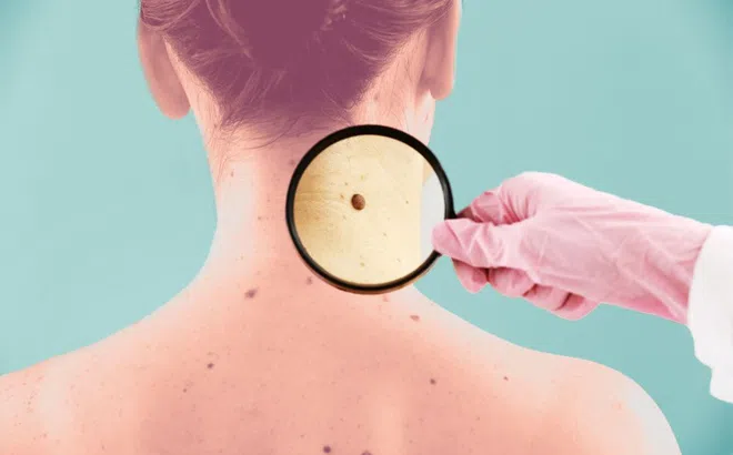 Kiểu nốt ruồi cảnh báo nguy cơ ung thư