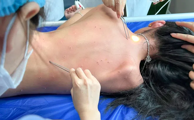 Hai mẹ con ở Hải Phòng bị ong đốt 100 mũi vì khách sạn phá tổ ong