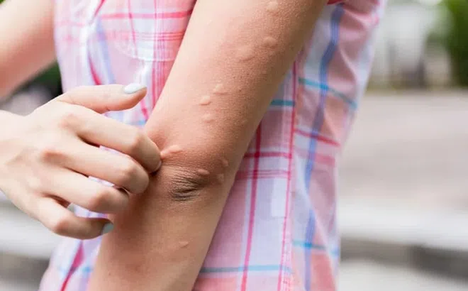 Lý do bạn bị muỗi đốt nhiều hơn người khác