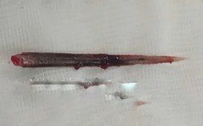 Hy hữu, một người bị đuôi cá đuối đâm thủng phổi