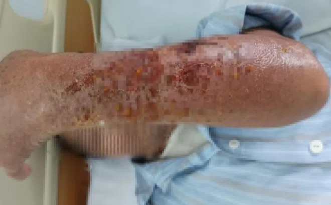 Cánh tay chảy dịch, nhiễm trùng sau khi bị mèo cào