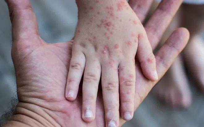 Trẻ mắc tay chân miệng tăng mạnh ở miền Tây