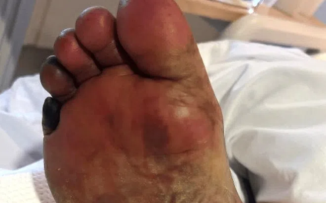 Loại vi khuẩn 'ăn thịt người' đang lây lan tại Nhật Bản