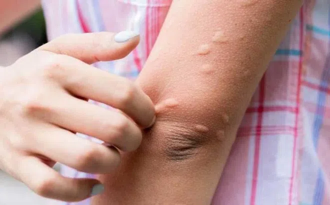 Cảnh giác với bệnh viêm não Nhật Bản với trẻ em trong mùa hè