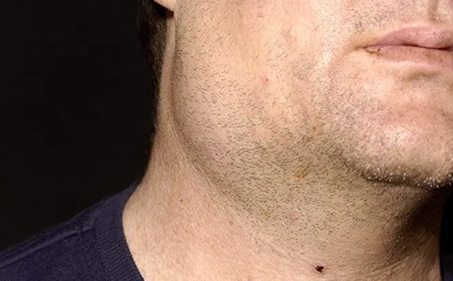 Việc cần làm để bệnh quai bị nhanh khỏi