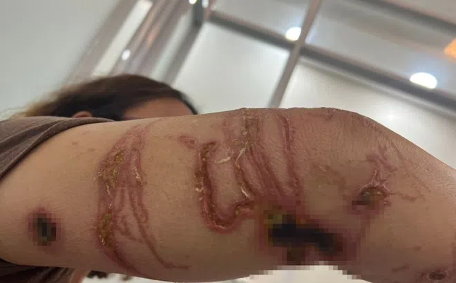 Tay chân lở loét sau khi tắm biển