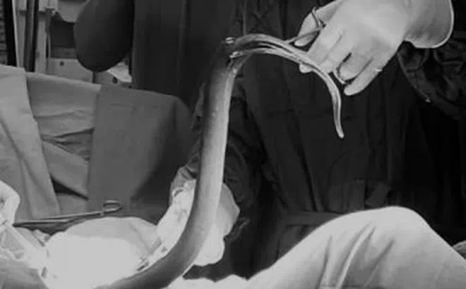 Nam thanh niên suýt mất mạng vì nhét lươn vào hậu môn