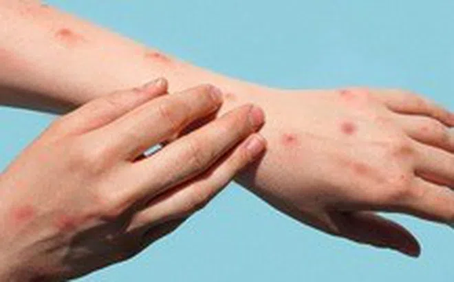 Tổ chức Y tế thế giới họp khẩn vì bệnh đậu mùa khỉ