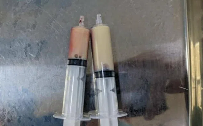 Người đàn ông đi cấp cứu với cơn đau bụng dữ dội