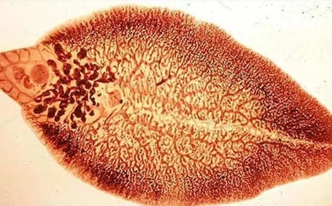 Ho ra máu cảnh giác với sán lá phổi