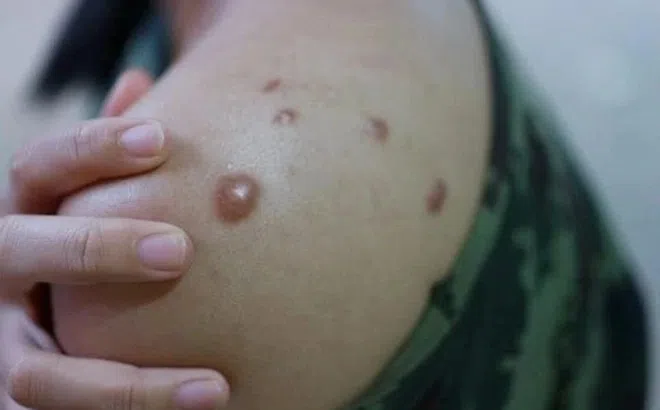 Đặc trưng của vết ban đậu mùa khỉ