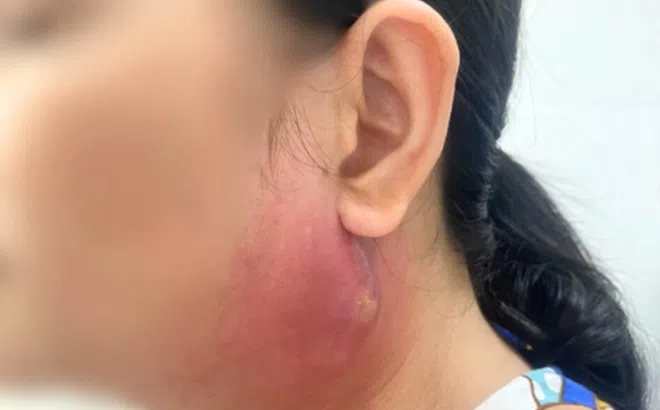 Người phụ nữ phải vào phòng phẫu thuật chỉ vì nốt mụn nhọt