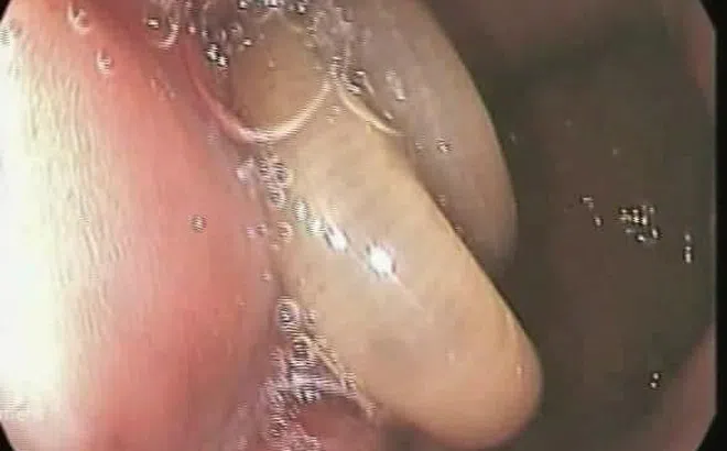 Giun dài đến 10 cm lúc nhúc trong cơ thể người đàn ông