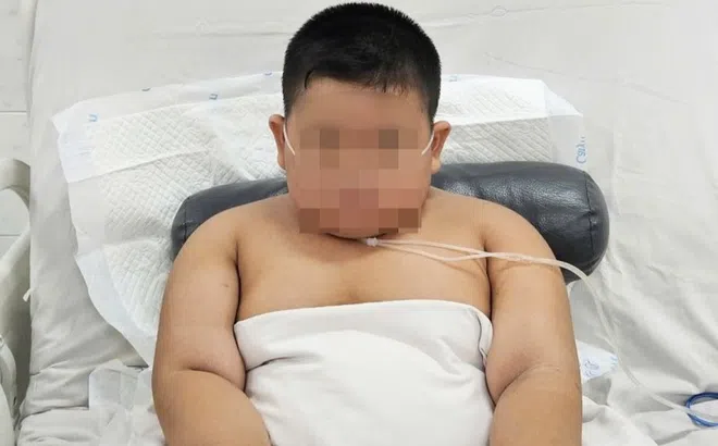 Bé trai tăng 35 kg trong 6 tháng, nguy kịch sau 3 ngày nhiễm cúm