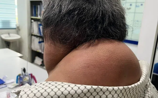 Mắc bệnh 'người gấu' vì thói quen xấu khó bỏ