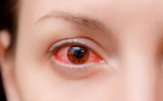 Làm gì để tránh bị đau mắt đỏ?